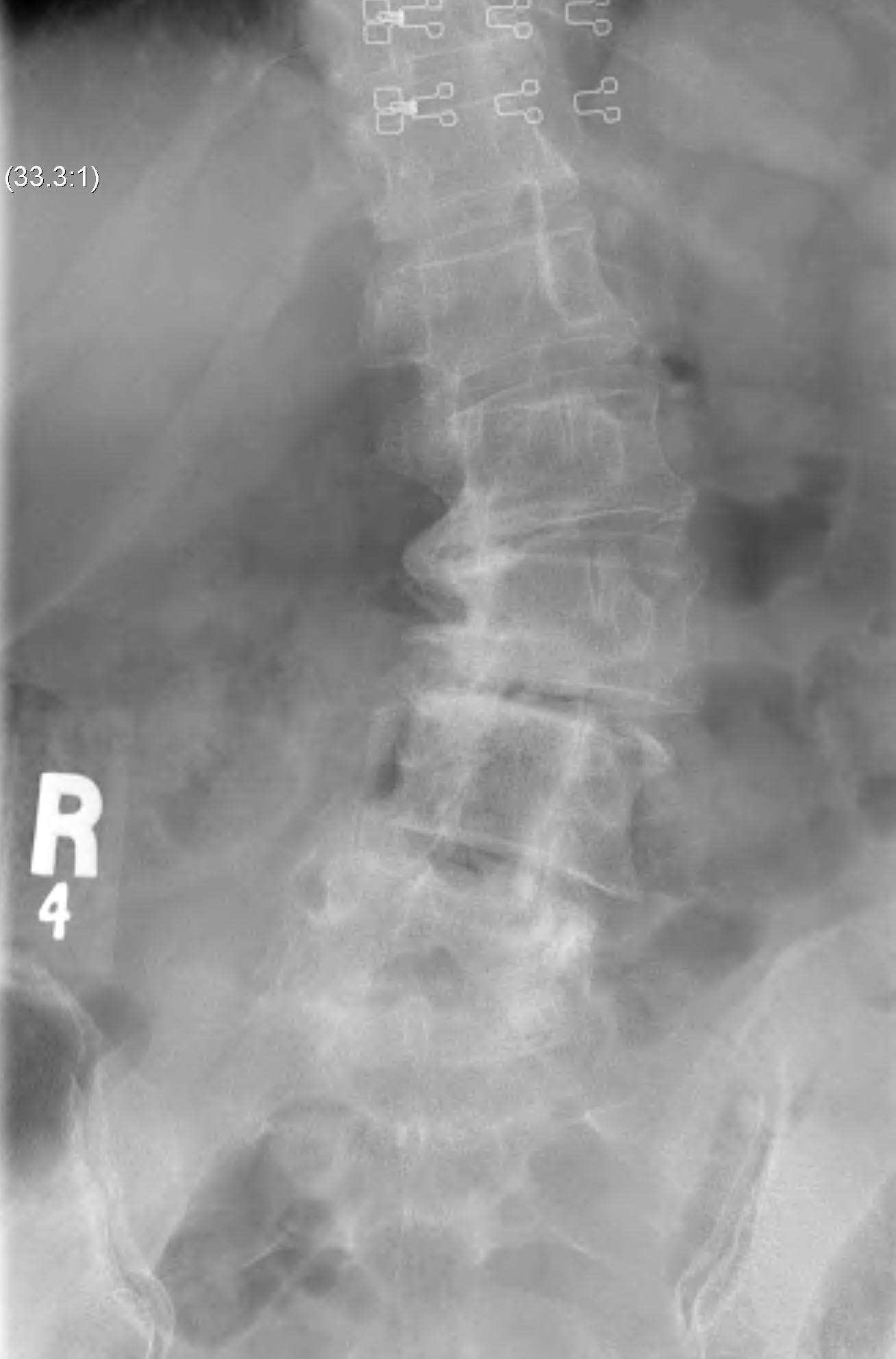 Lumbar Degenerative Scoliosis